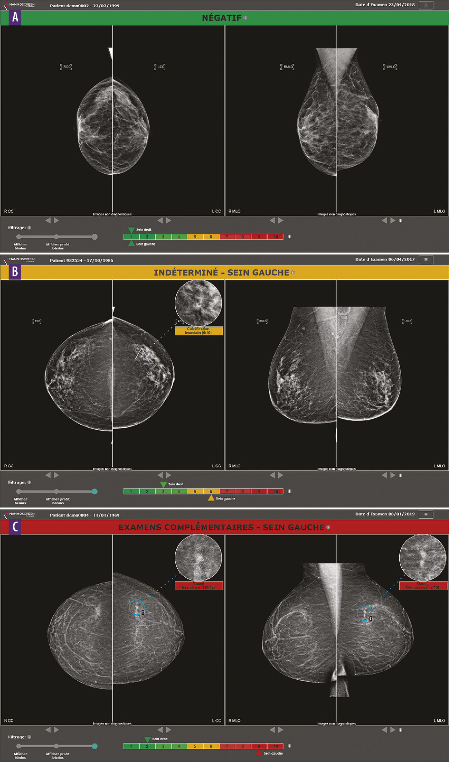 Intelligence artificielle en mammographie et dépistage du cancer du sein - Figure 2