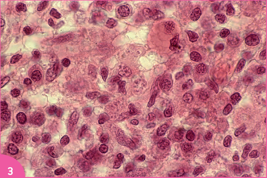 Des ulcères tropicaux - Figure 3
