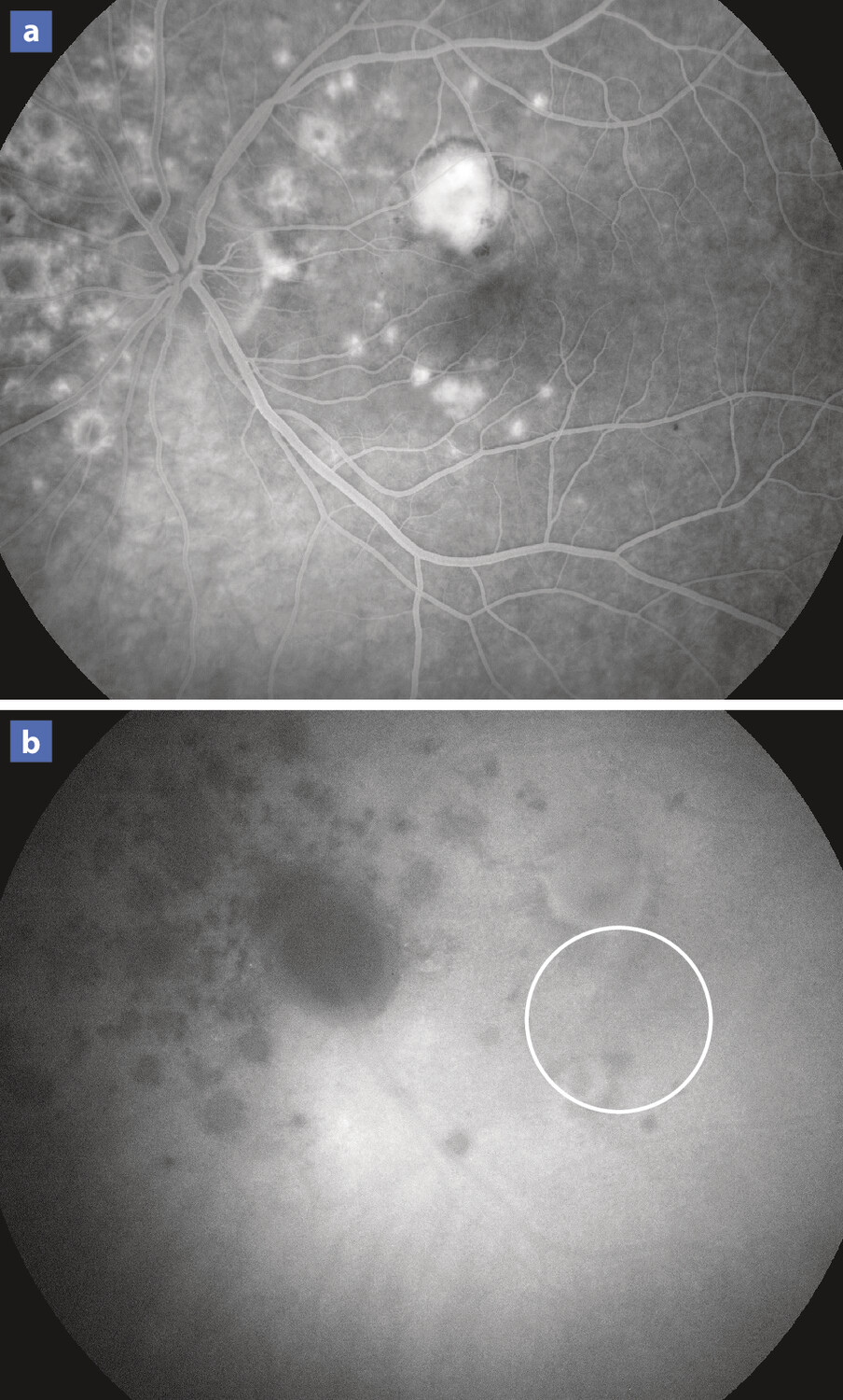 Intérêt de l’angiographie à la fluorescéine dans le diagnostic de taches blanches du fond d’œil - Figure 4