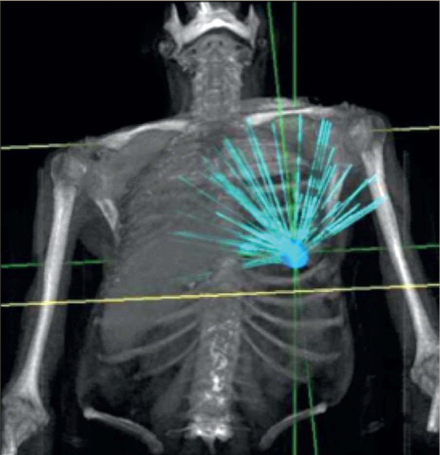 Traitement d'un cancer du poumon par radiothérapie stéréotaxique - Figure 3