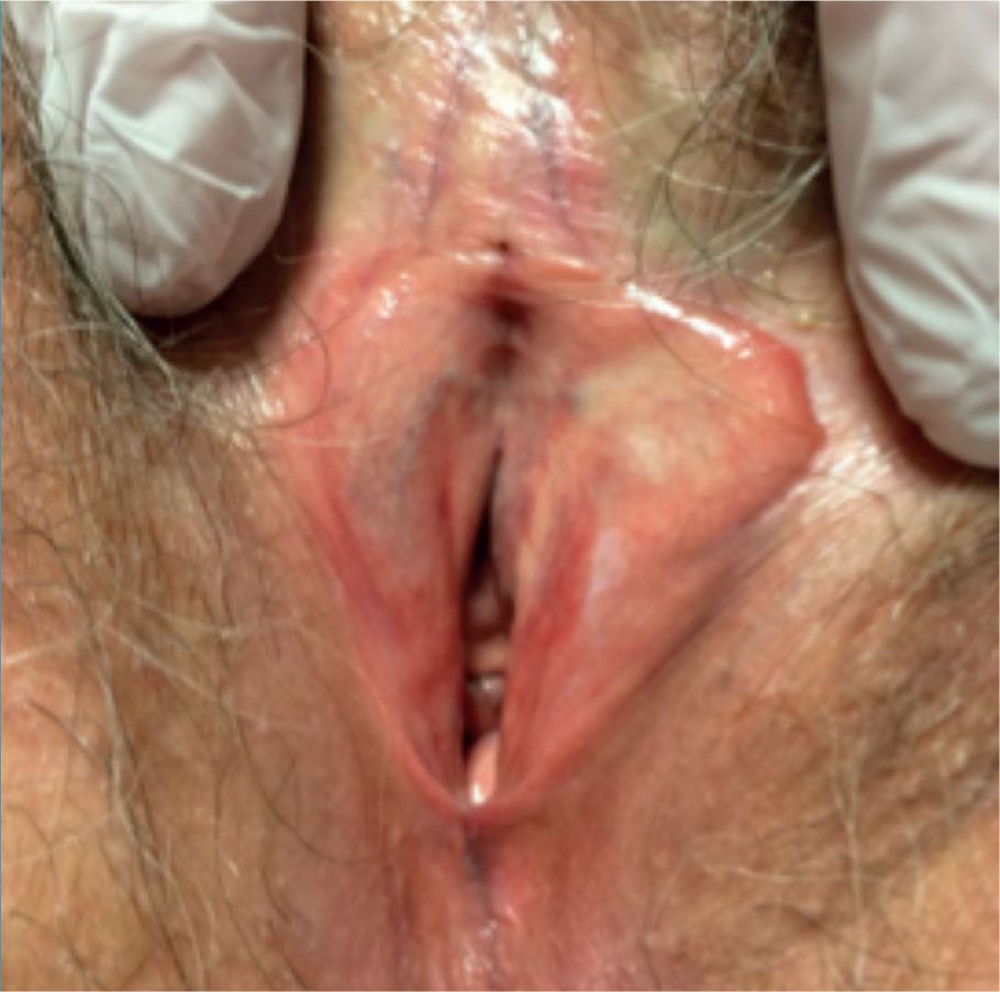 Consultation gynéco-dermatologique de pathologie vulvaire - Figure 4