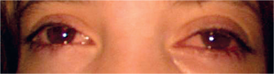 La rosacée oculaire - Figure 10.