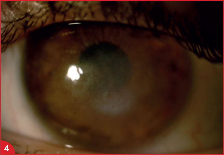 Sous lentilles de contact, une kératite herpétique peut cacher une kératite amibienne - Figure 4