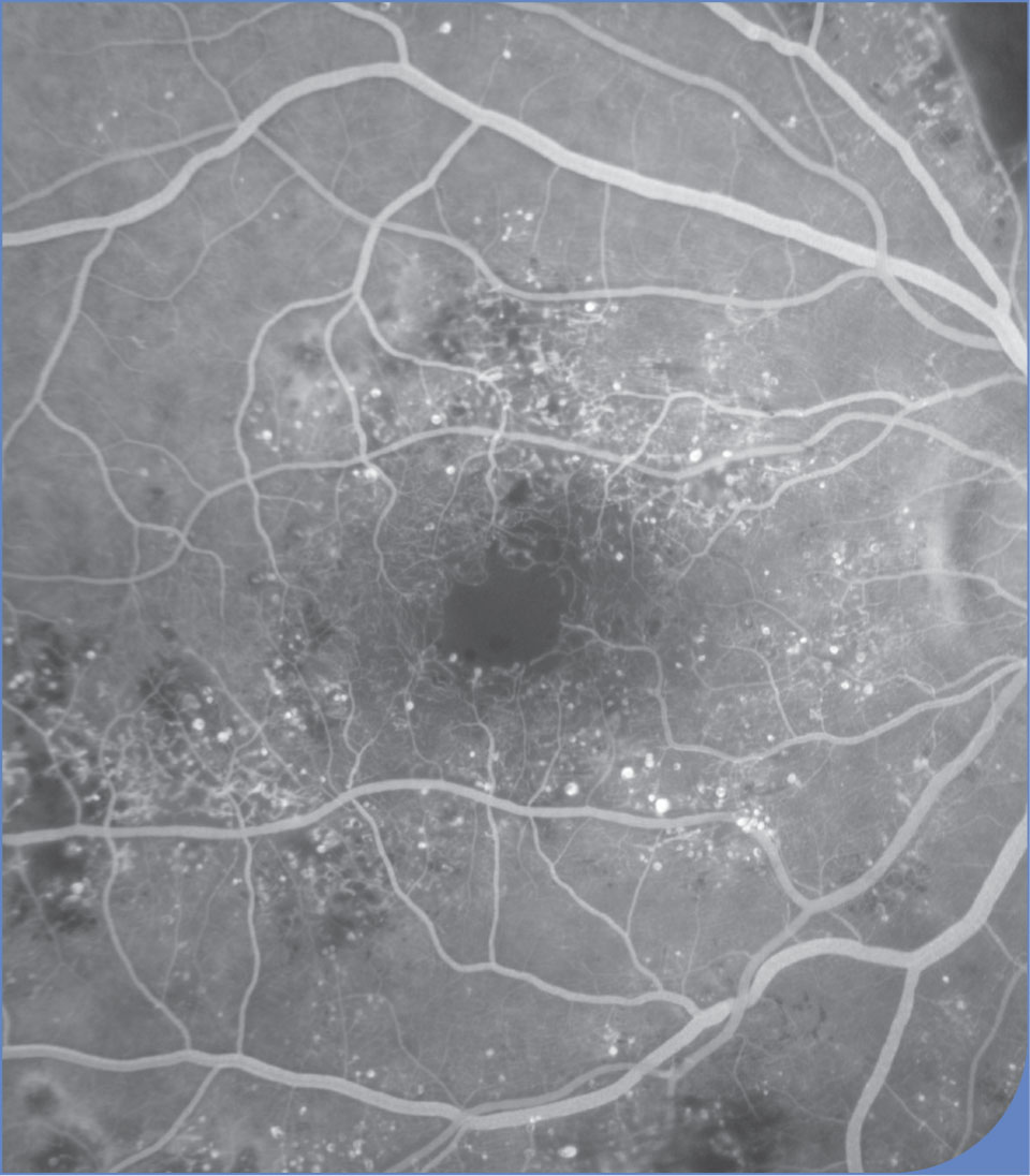 Bilan d'imagerie d'un œdème maculaire diabétique en OCT et en angiographie à la fluorescéine - Figure 7