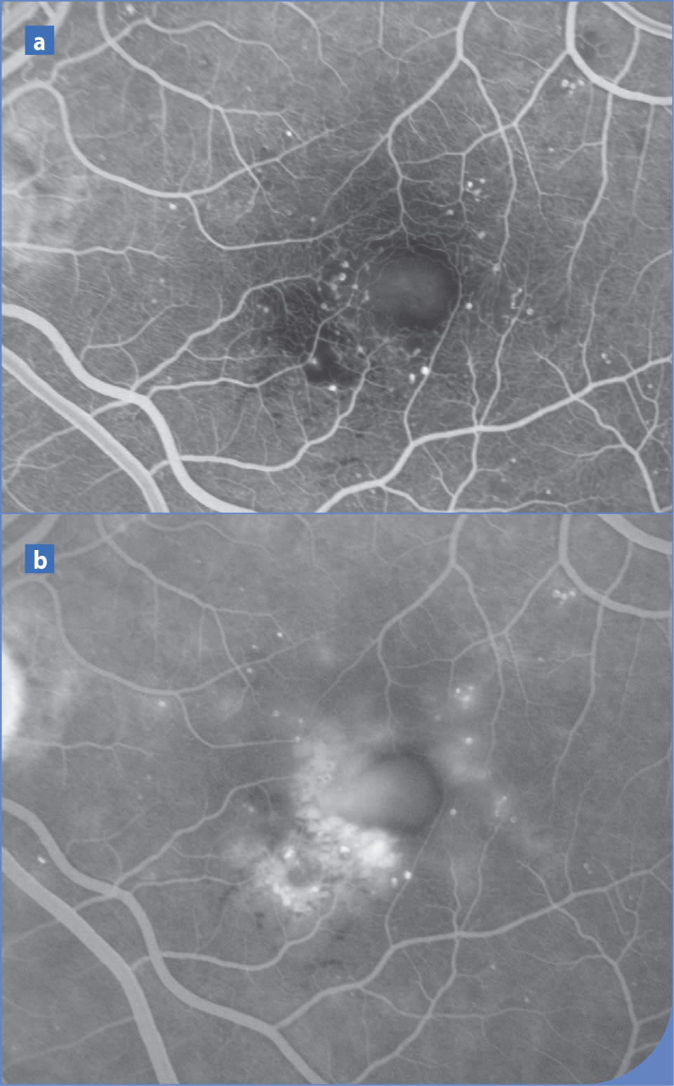 Bilan d'imagerie d'un œdème maculaire diabétique en OCT et en angiographie à la fluorescéine - Figure 6