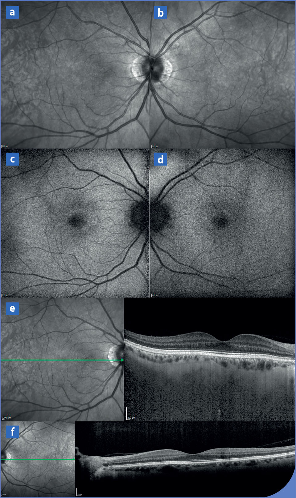 <i>Begnin yellow dot maculopathy</i> : une nouvelle entité avec une transmission autosomique dominante - Figure 5