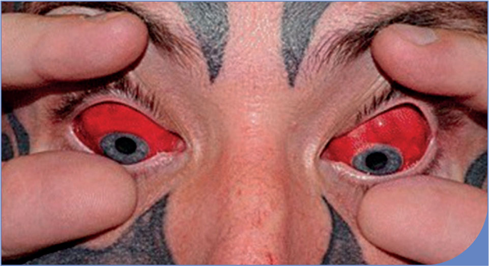 Complications oculaires liées aux tatouages conjonctivaux - Figure