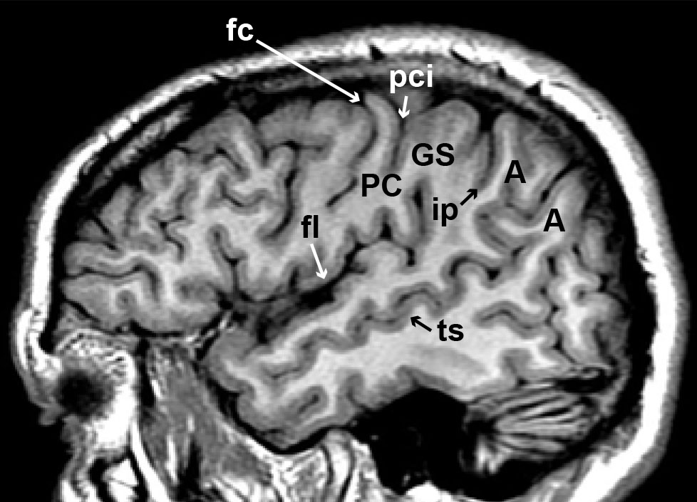 Anatomie du cortex cérébral : lobe pariétal - Figure 5