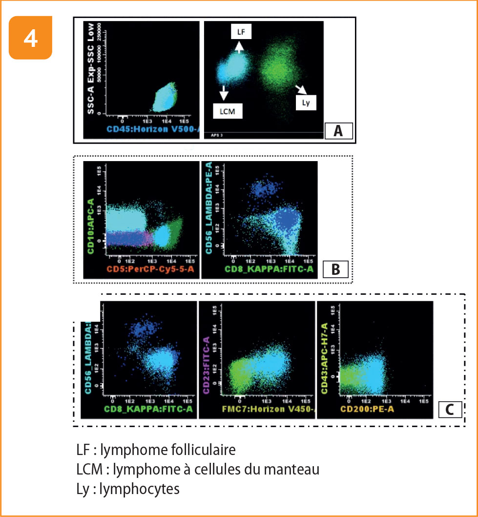 Lymphome composite : association d'un lymphome folliculaire et d'un lymphome à cellules du manteau - Figure 4