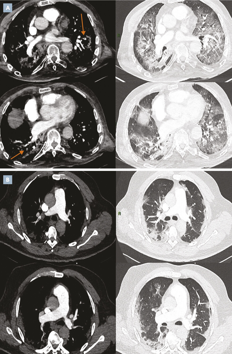 Embolie pulmonaire et Covid-19 : mécanismes, diagnostic, prise en charge et prévention - Figure 1