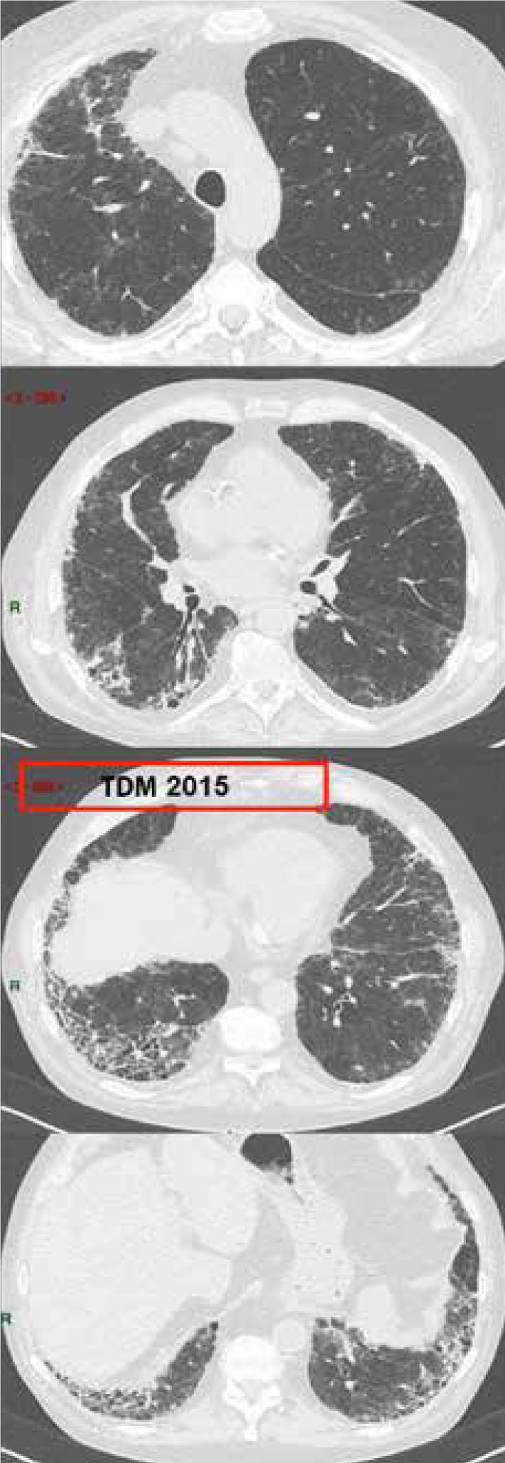 Asbestose ou fibrose pulmonaire idiopathique ? - Figure 3