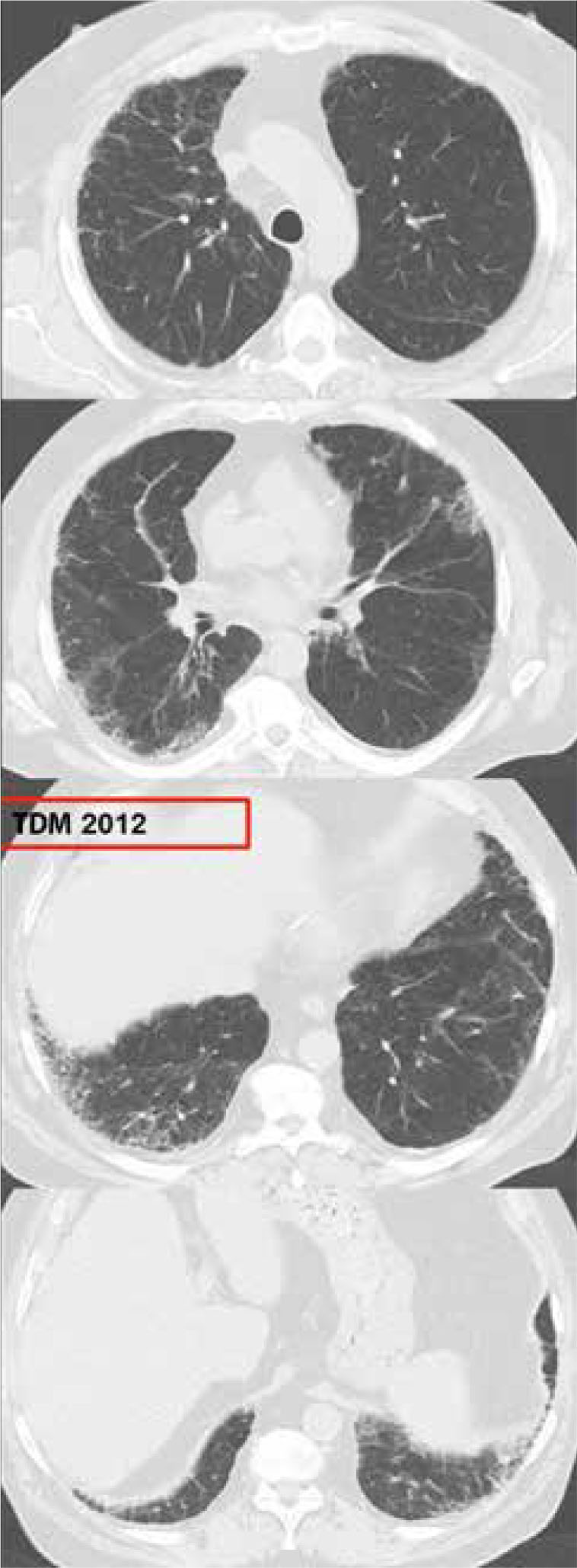 Asbestose ou fibrose pulmonaire idiopathique ? - Figure 1