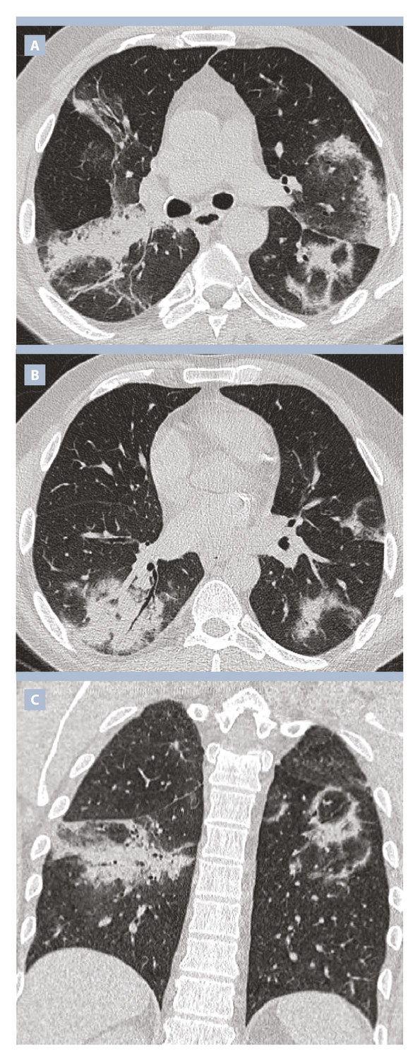 Imagerie tomodensitométrique des pneumopathies interstitielles diffuses idiopathiques : comment s’orienter ?  - Figure 6