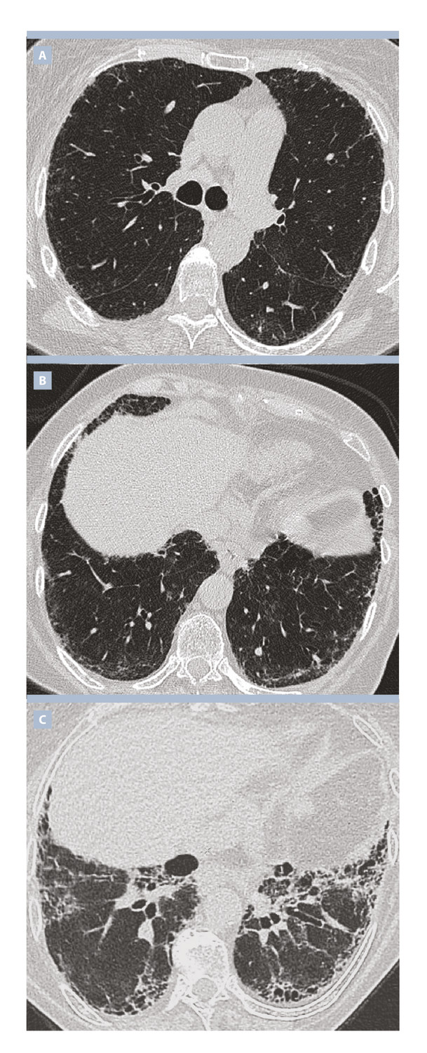 Imagerie tomodensitométrique des pneumopathies interstitielles diffuses idiopathiques : comment s’orienter ?  - Figure 2