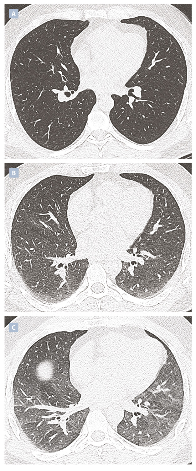 Critères de qualité du scanner thoracique réalisé pour une pneumopathie infiltrante diffuse - Figure 3