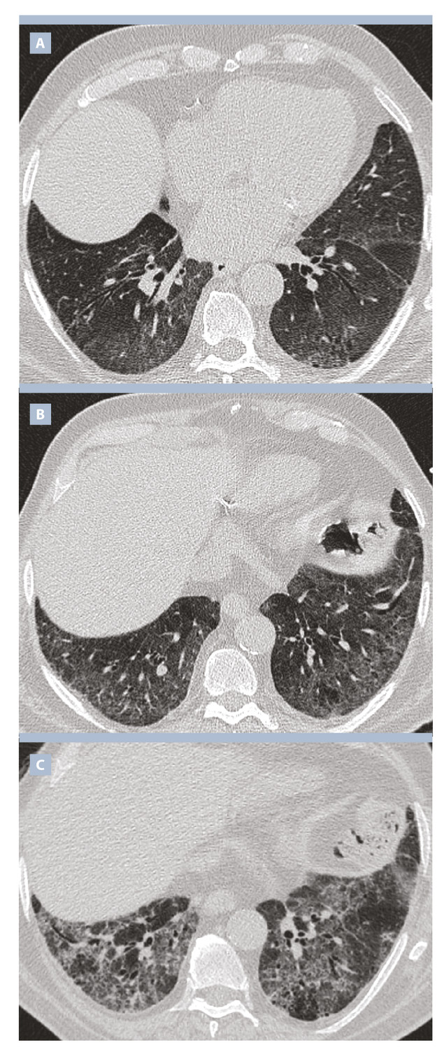 Imagerie tomodensitométrique des pneumopathies interstitielles diffuses idiopathiques : comment s’orienter ?  - Figure 3