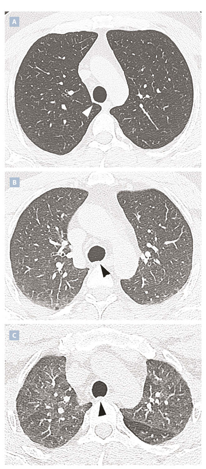 Critères de qualité du scanner thoracique réalisé pour une pneumopathie infiltrante diffuse - Figure 1