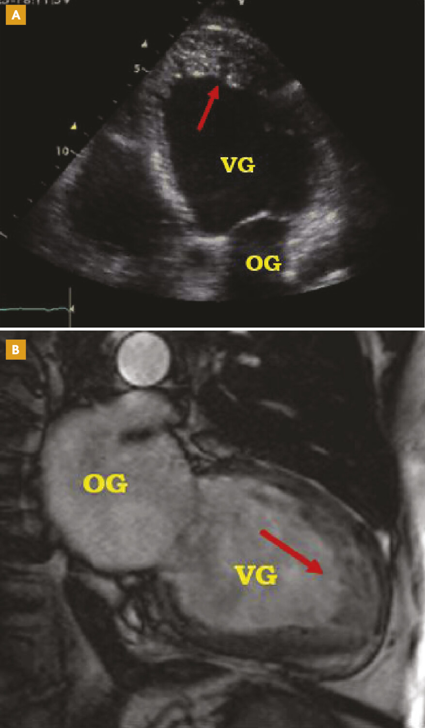 Actualités sur la non-compaction isoléedu ventricule gauche - Figure 1