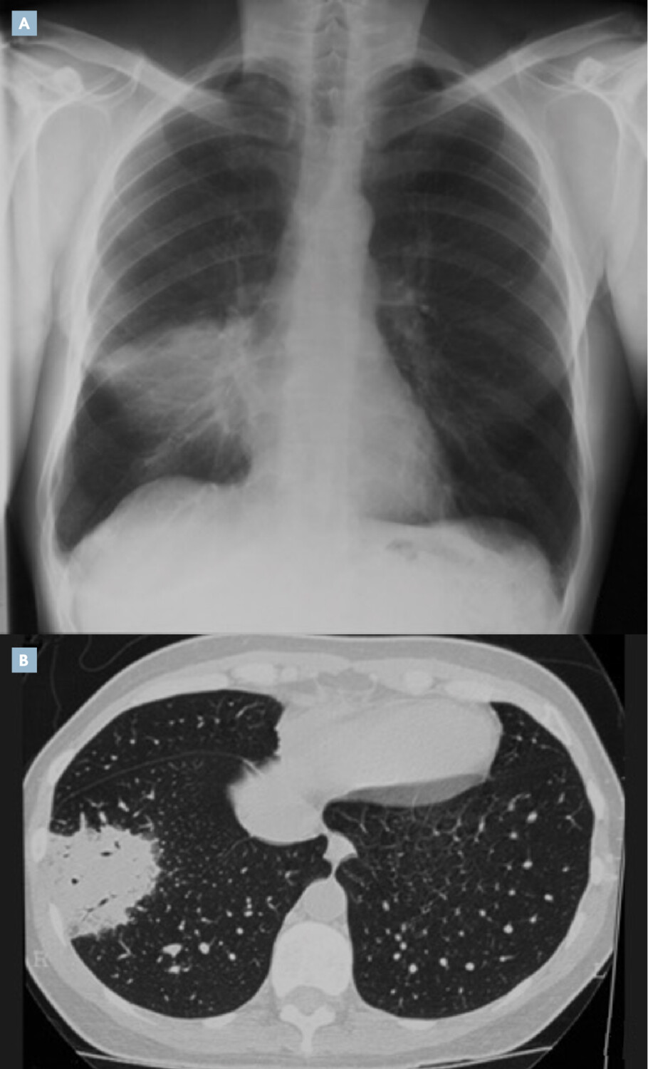 Les tumeurs pulmonaires rares - Figure 2