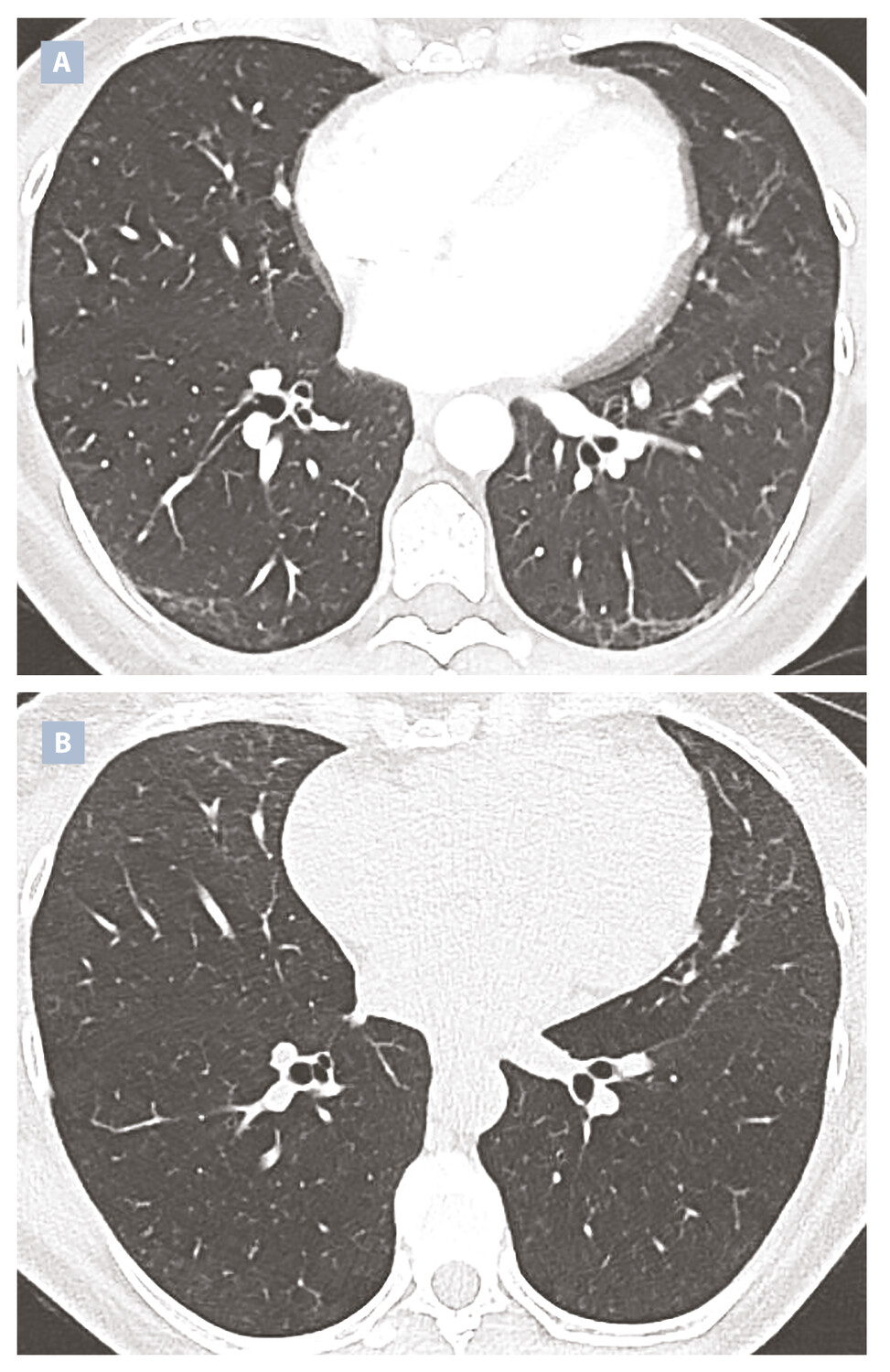 Critères de qualité du scanner thoracique réalisé pour une pneumopathie infiltrante diffuse - Figure 4