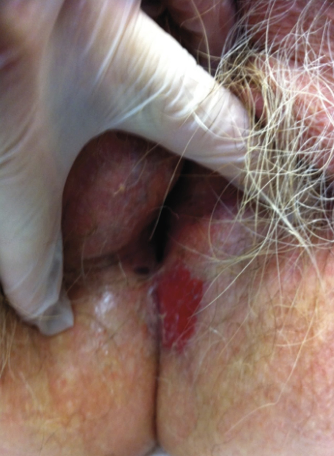 Consultation gynéco-dermatologique de pathologie vulvaire - Figure 7