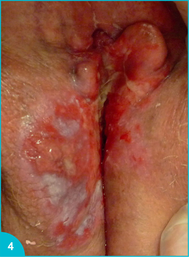 Maladie de Paget vulvaire : difficulté diagnostique et thérapeutique - Figure 4