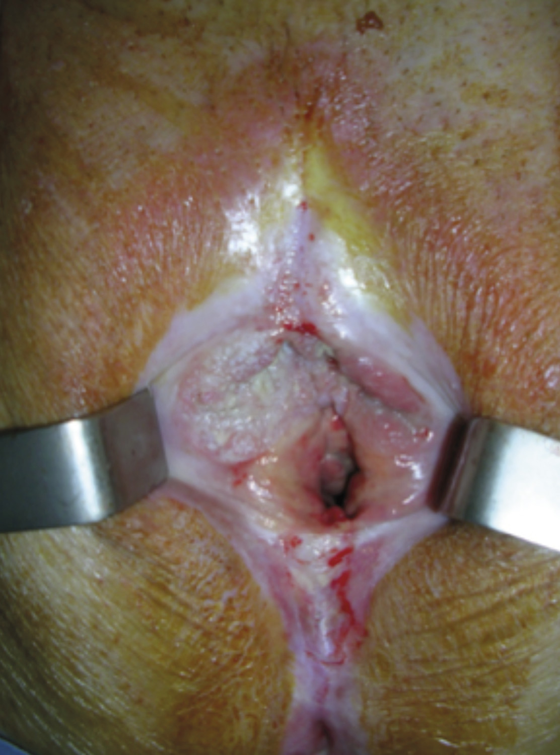 Consultation gynéco-dermatologique de pathologie vulvaire - Figure 9
