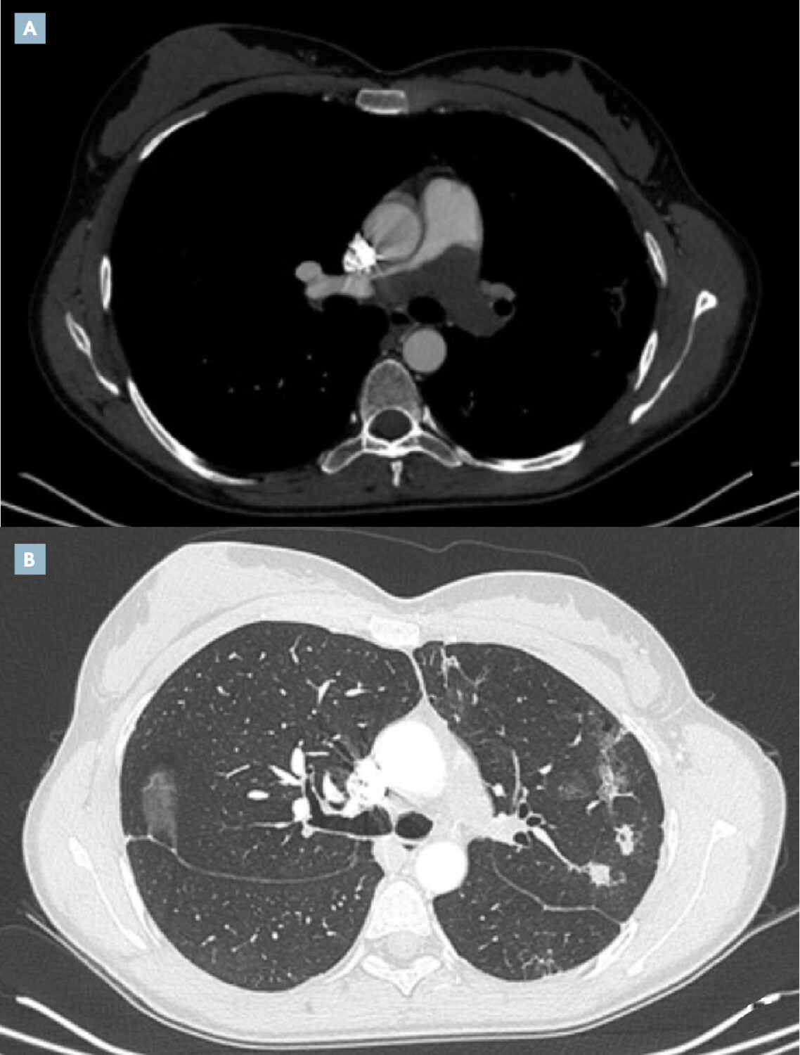 Les tumeurs pulmonaires rares - Figure 1
