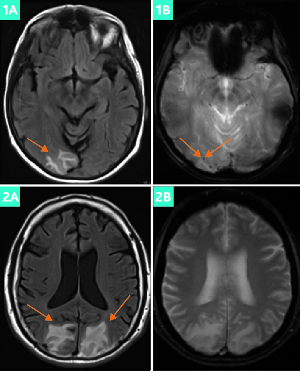 Angiopathie amyloïde cérébrale sporadique et maladie d’Alzheimer : que savons-nous de leur coexistence ? - Figure 2