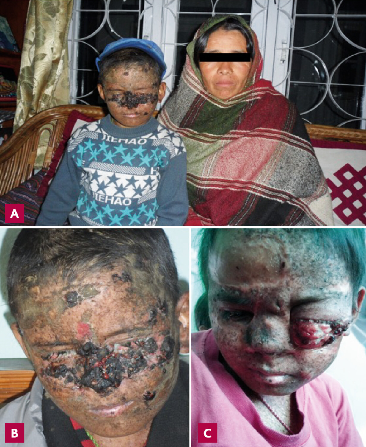 Xeroderma pigmentosum au Népal : souffrance et traumatismes d’une peau non réparée - Figure 1