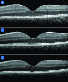 Intérêt de l’OCT dans le bilan des taches blanches du fond d’œil - Figure 1
