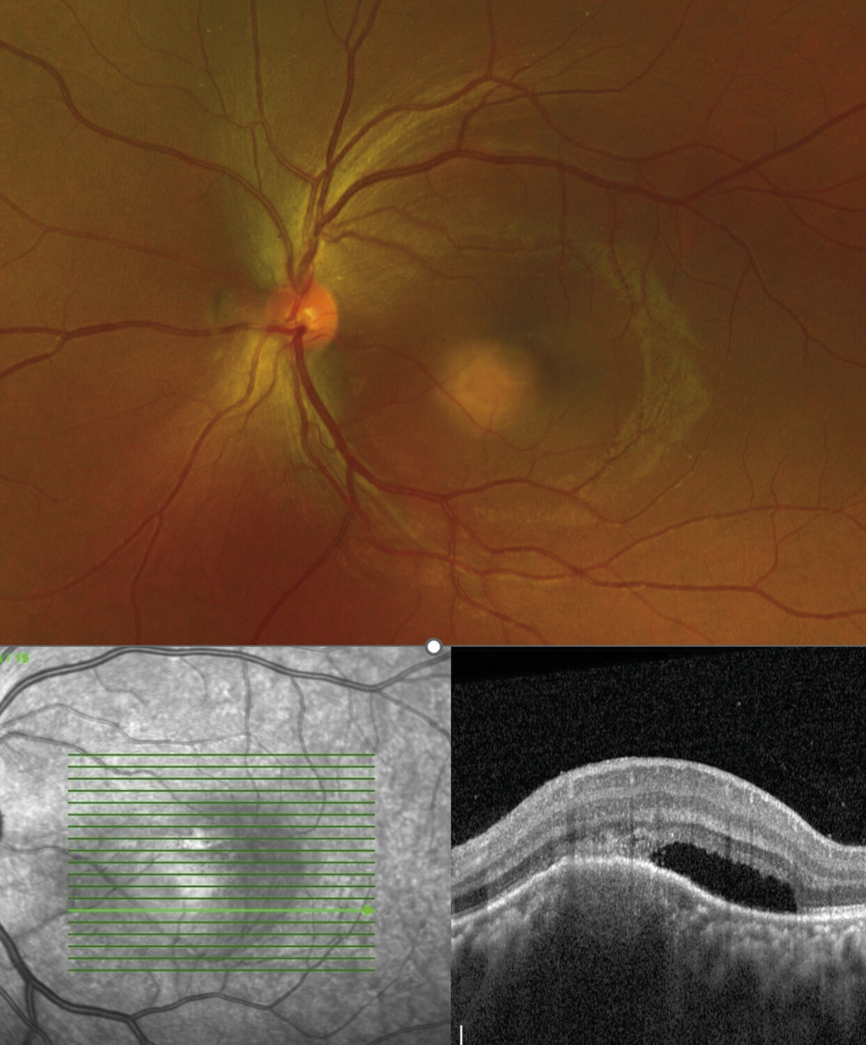 Tuberculose oculaire : démarche diagnostique et thérapeutique - Figure 2