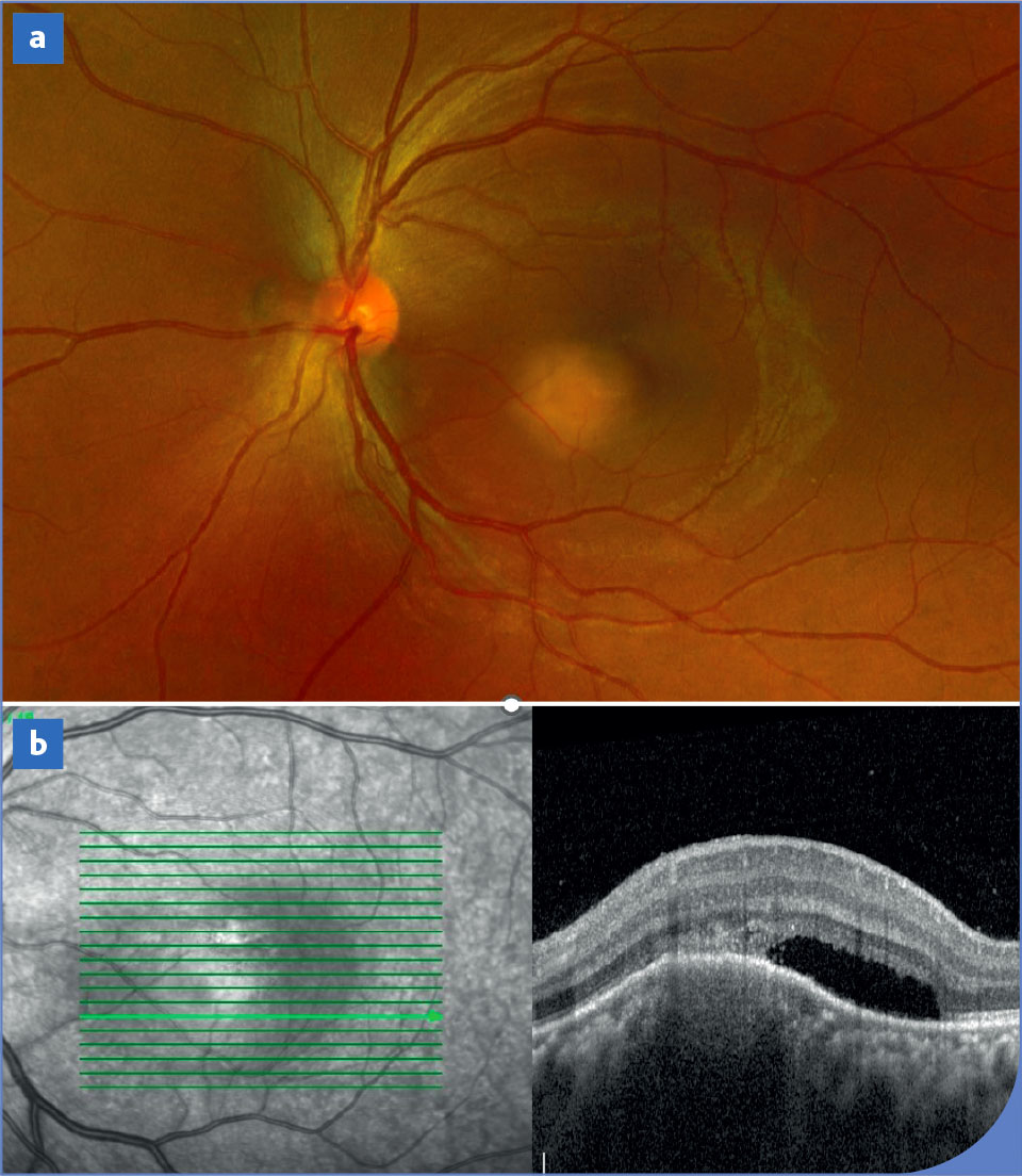 Tuberculose oculaire : démarche diagnostique et thérapeutique - Figure 2