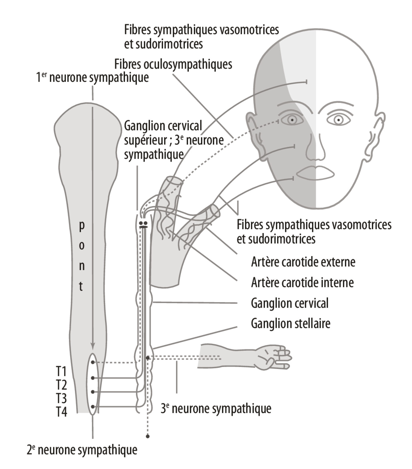 Le syndrome d’Harlequin - Figure 2