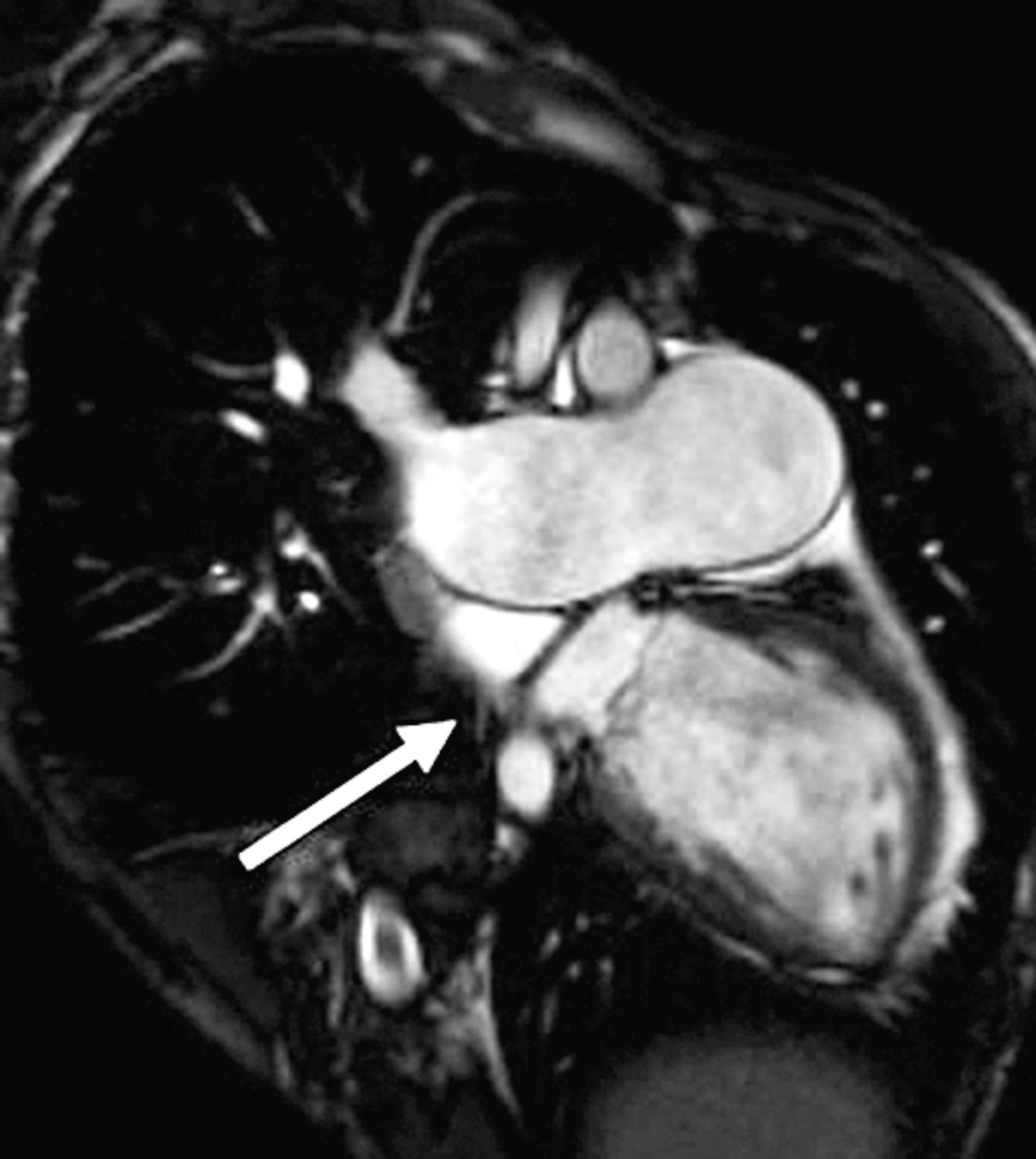 Cœur triatrial et syndrome coronarien aigu - Figure 4