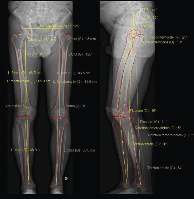 Étude GREPI – Très GRandes tailles chez les adolescent(e)s : intérêt de l’EPIphysiodèse bilatérale des genoux en cas de demande de traitement  - Figure 5