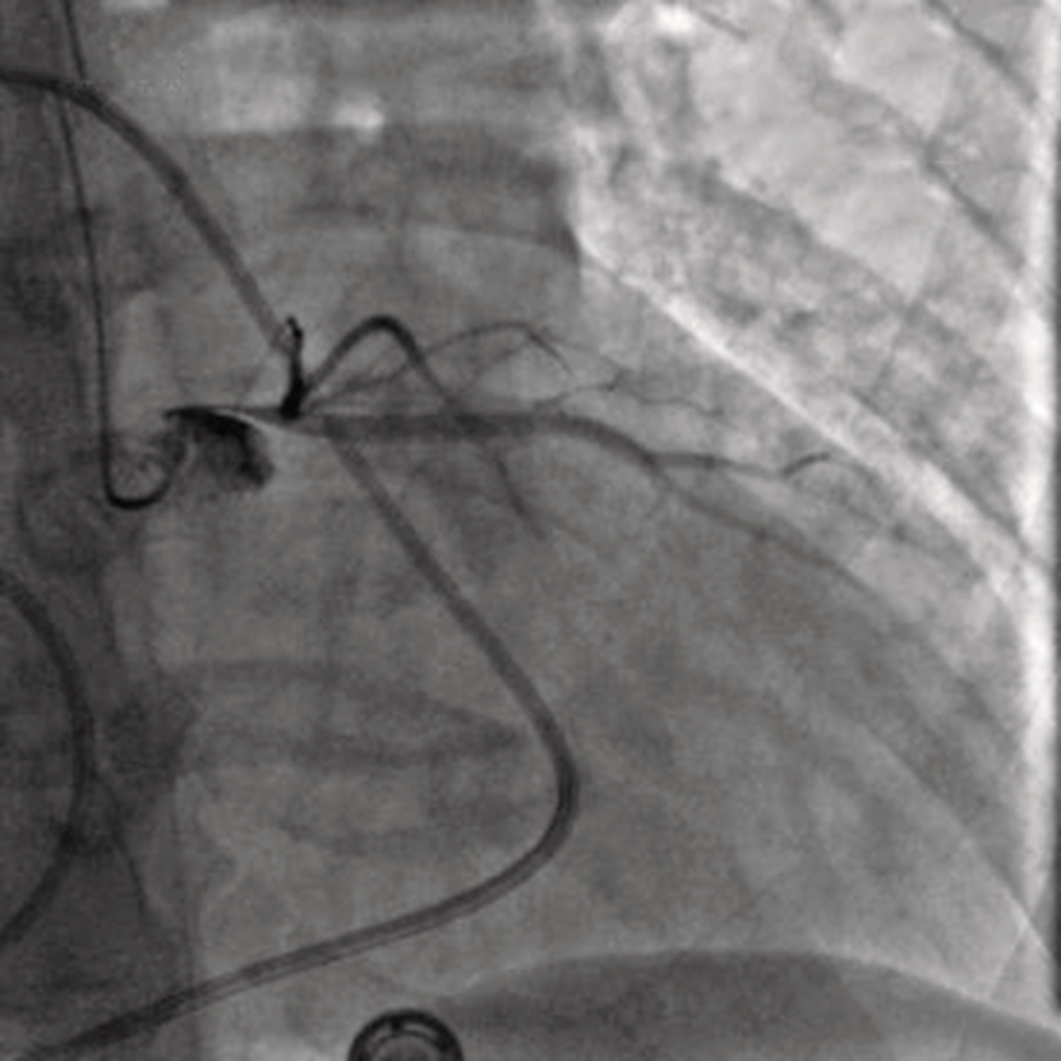 Cœur triatrial et syndrome coronarien aigu - Figure 3