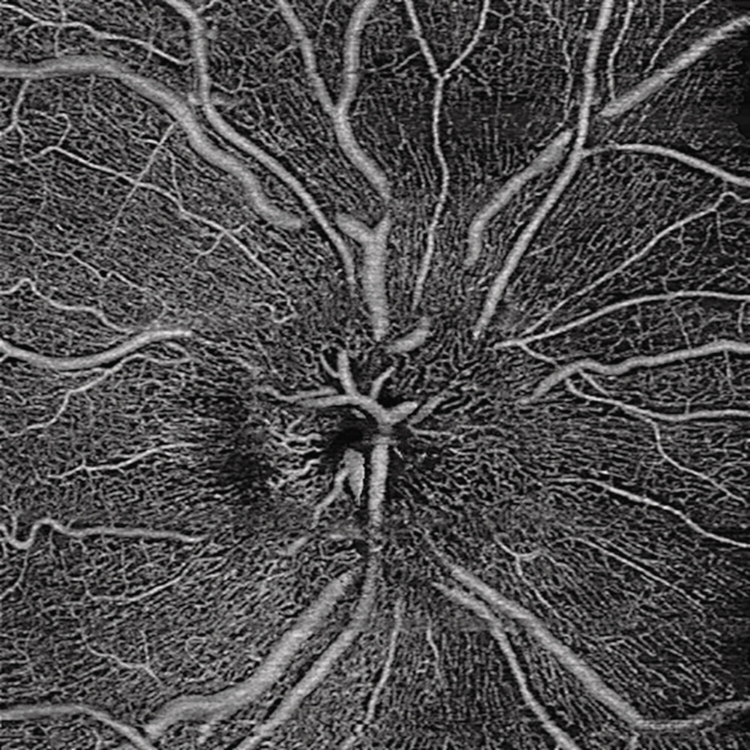 OCT-angiographie en neuro-ophtalmologie - Figure 3