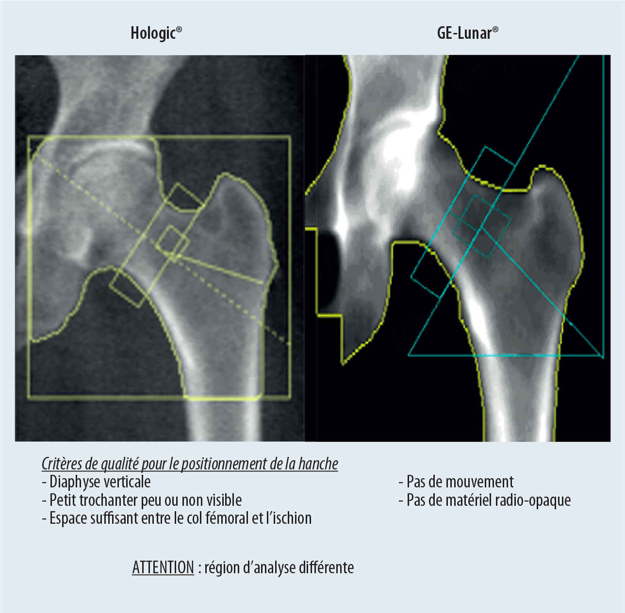 Densitométrie osseuse et VFA - Figure 3