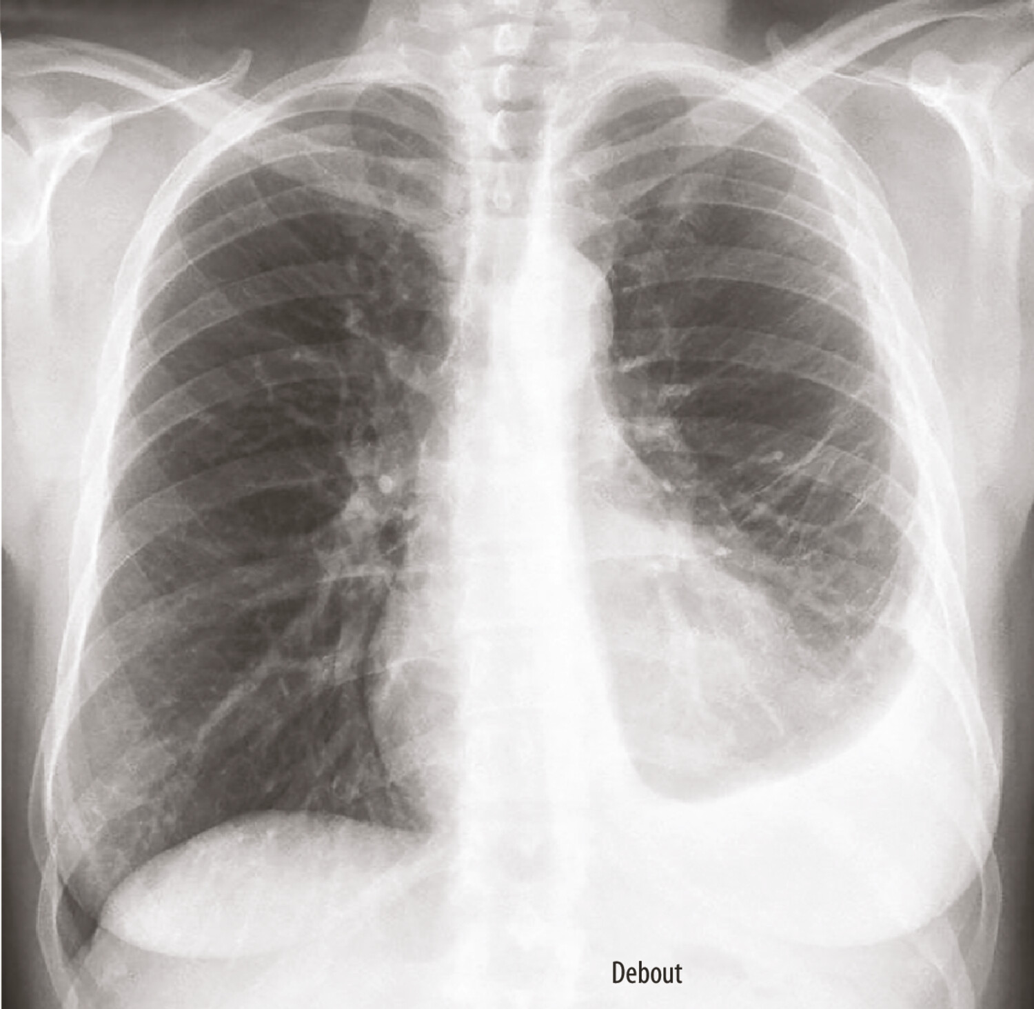 Lupus érythémateux systémique et poumon - Figure 1