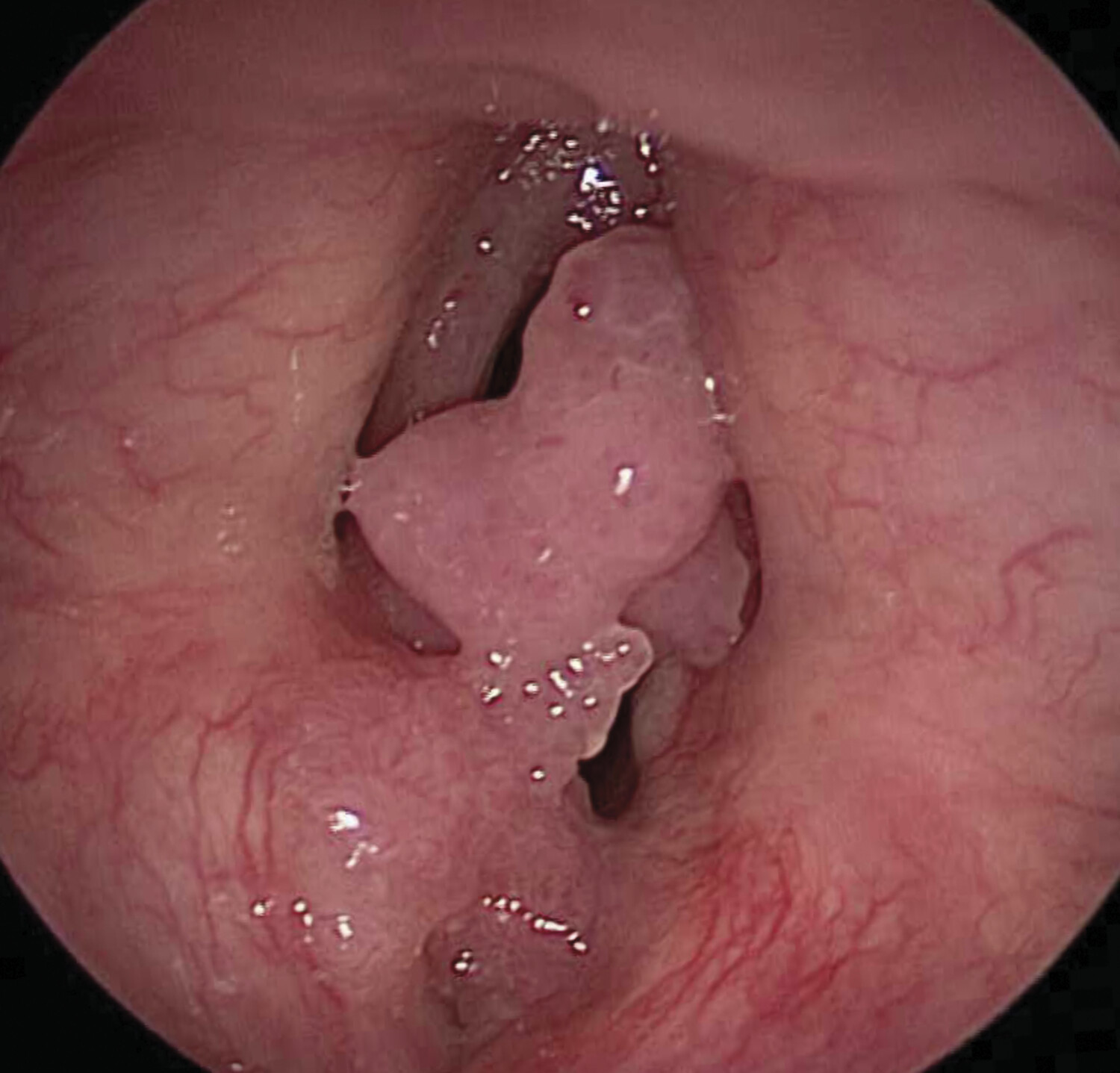 Dyspnée laryngée de l’enfant - Figure 5