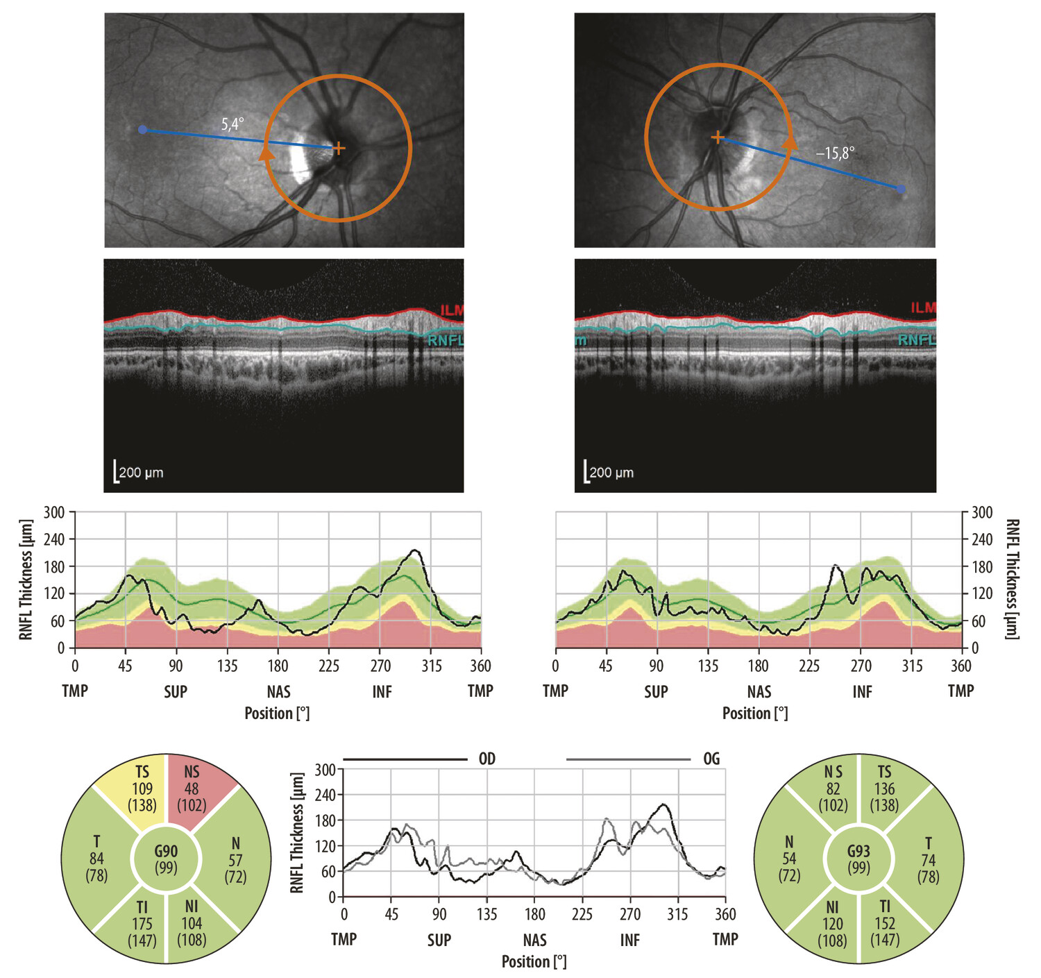 Gliome du nerf optique et amblyopie  - Figure 3