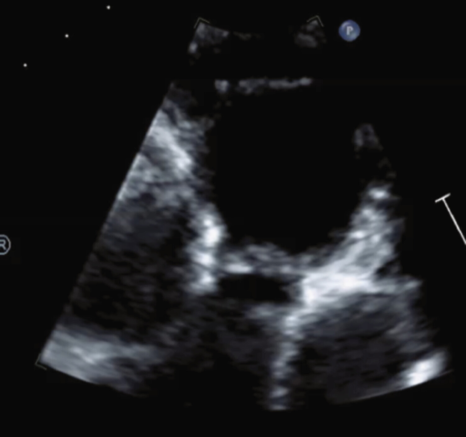 Intérêt de l’imagerie multimodale dans la prise en charge des cardiopathies congénitales  - Figure 4