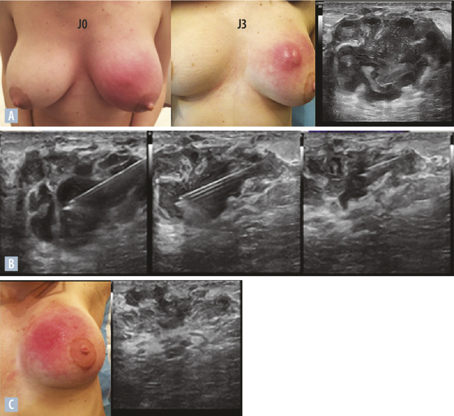 Diagnostic et prise en charge des complications inflammatoires ou infectieuses de l’allaitement maternel - Figure 3