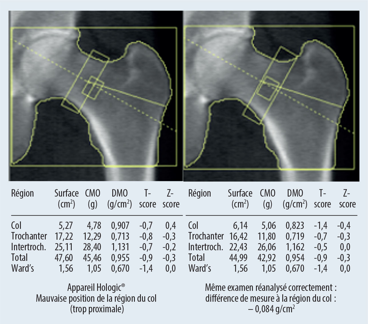 Densitométrie osseuse et VFA - Figure 5