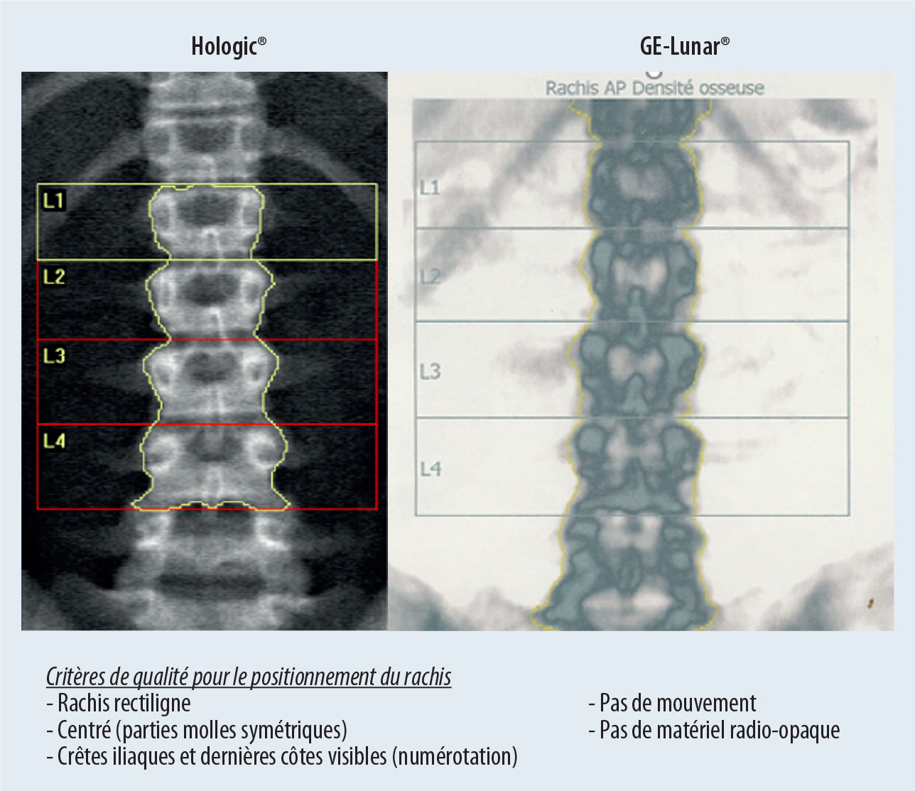 Densitométrie osseuse et VFA - Figure 2