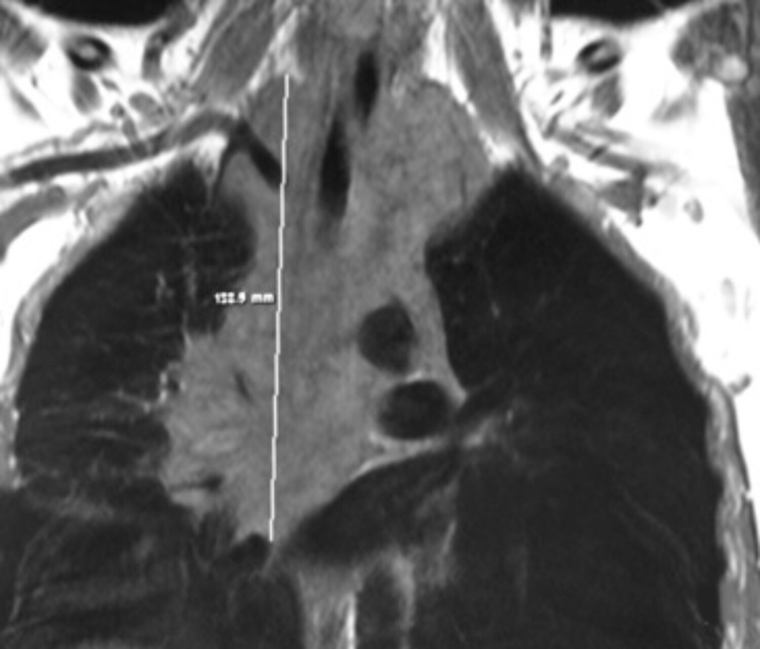 Les tumeurs pulmonaires rares - Figure 3