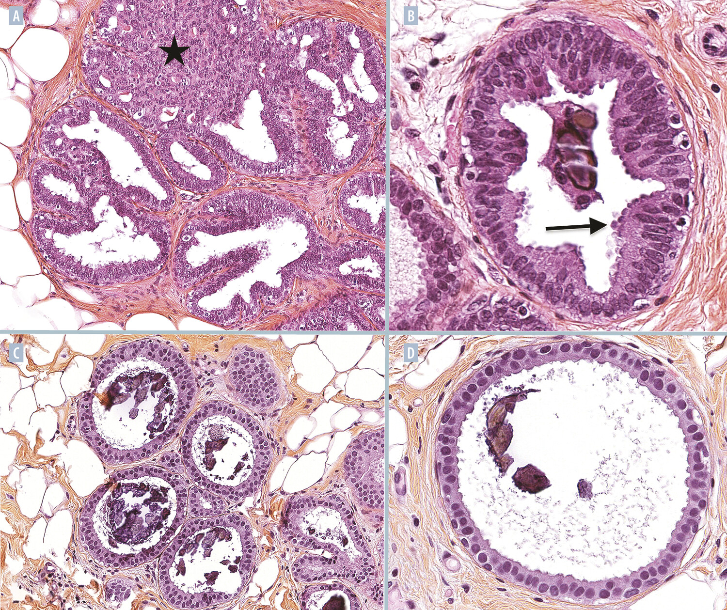 Anatomopathologie des proliférations mammaires intraépithéliales - Figure 2