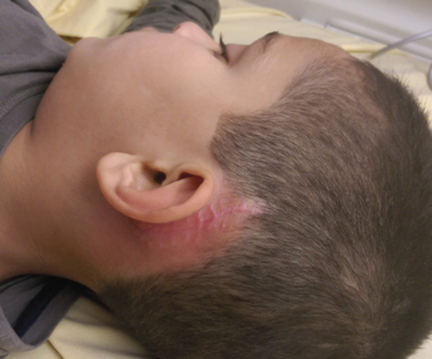 Mastoïdite aiguë sur implant cochléaire chez un enfant - Figure 2