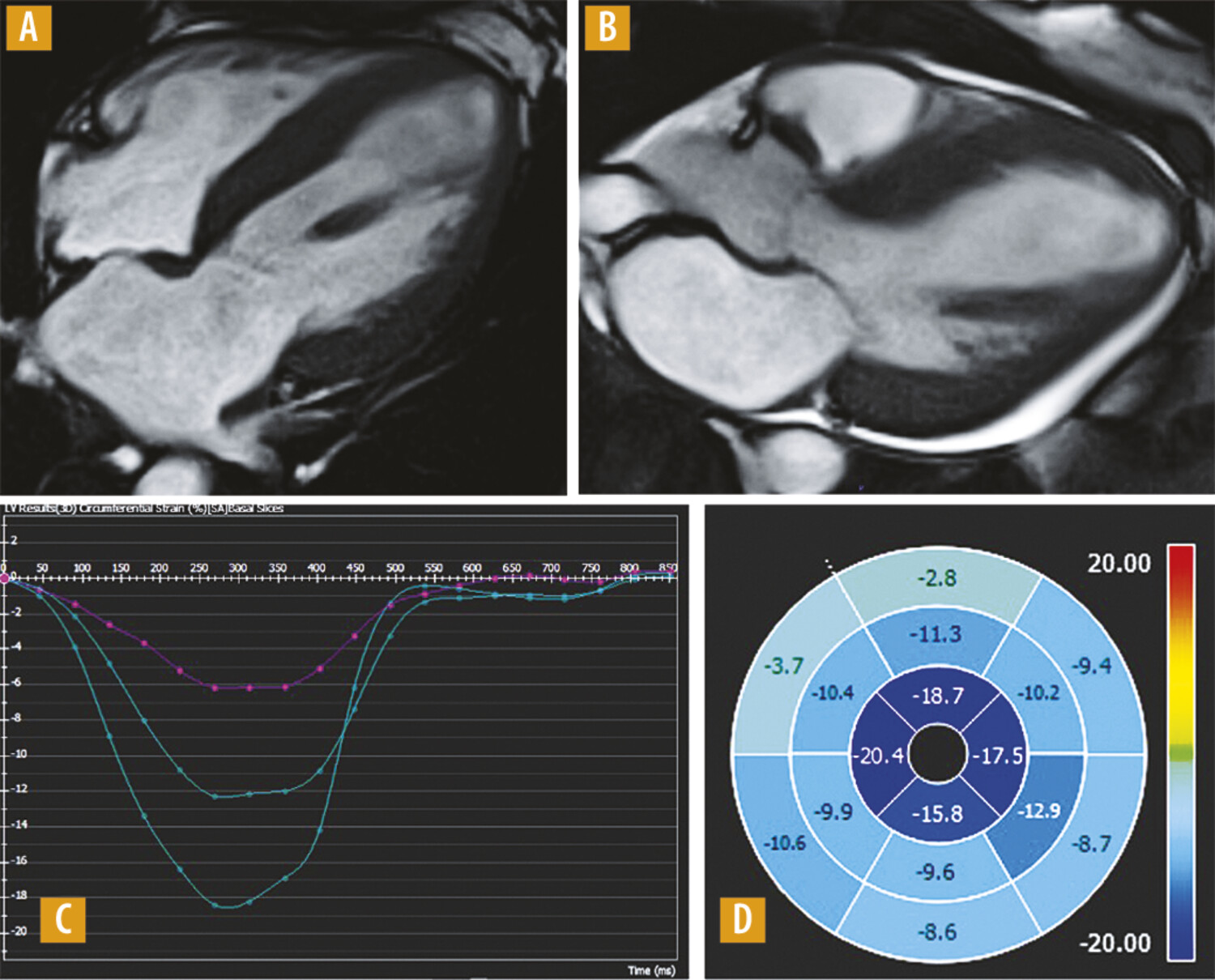 Le diagnostic de cardiopathie amyloïde en IRM cardiaque - Figure 1